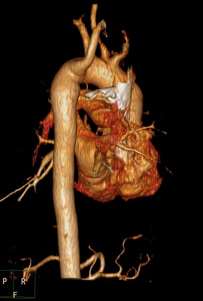 File:Aberrant right subclavian artery (Radiopaedia 67135-76475 B 2).jpg