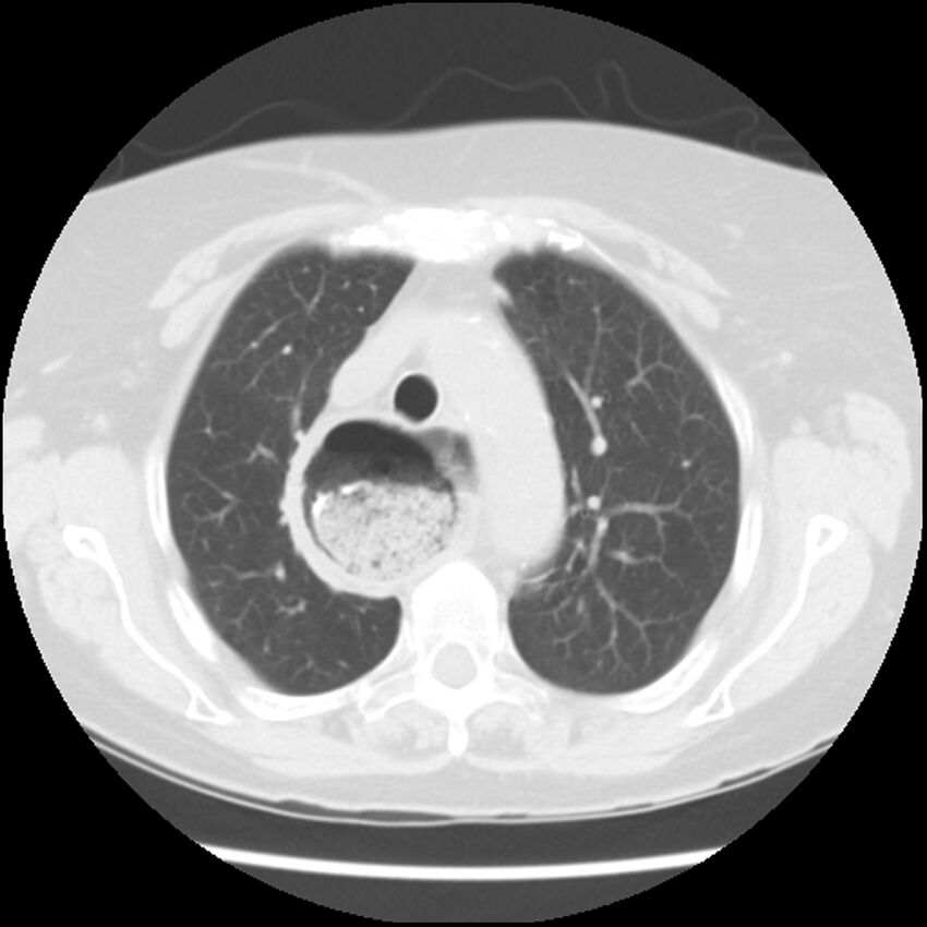 Achalasia (Radiopaedia 44094-47649 Axial lung window 16).jpg