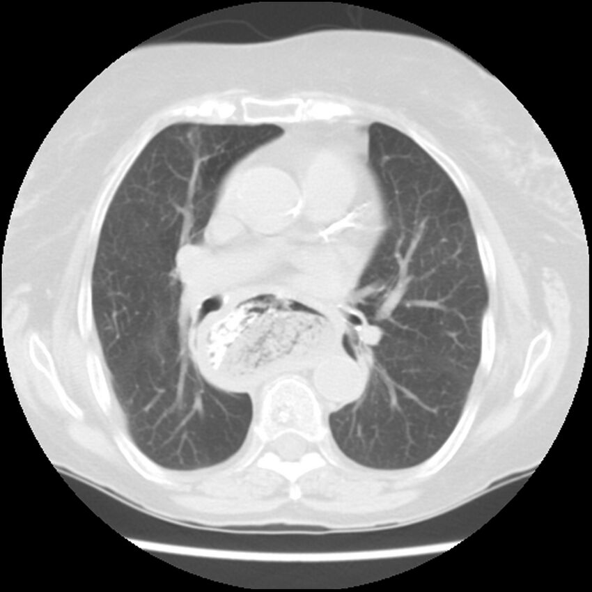 Achalasia (Radiopaedia 44094-47649 Axial lung window 29).jpg