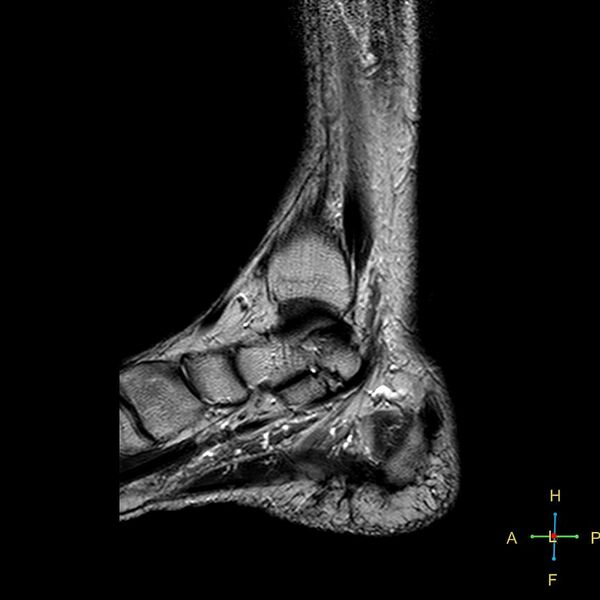 File:Achilles tendon complete tear (Radiopaedia 22834-22854 Sagittal T2 13).jpg