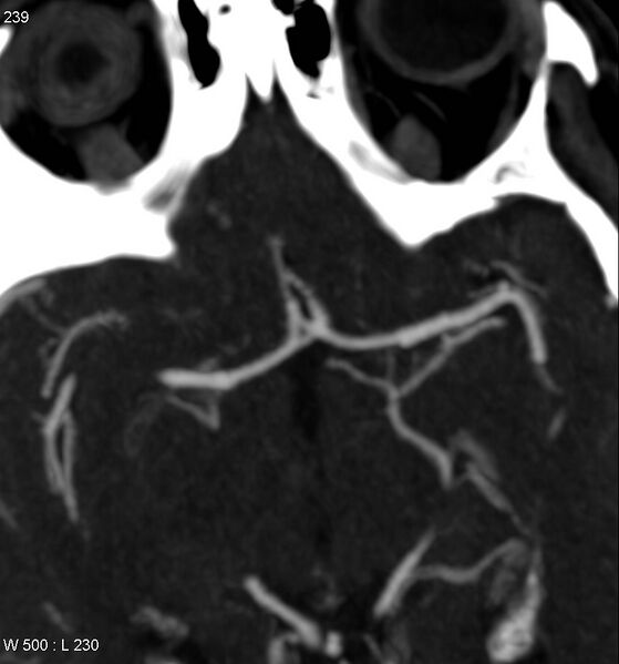 File:Acom artery fenestration - complex (Radiopaedia 6072).jpg