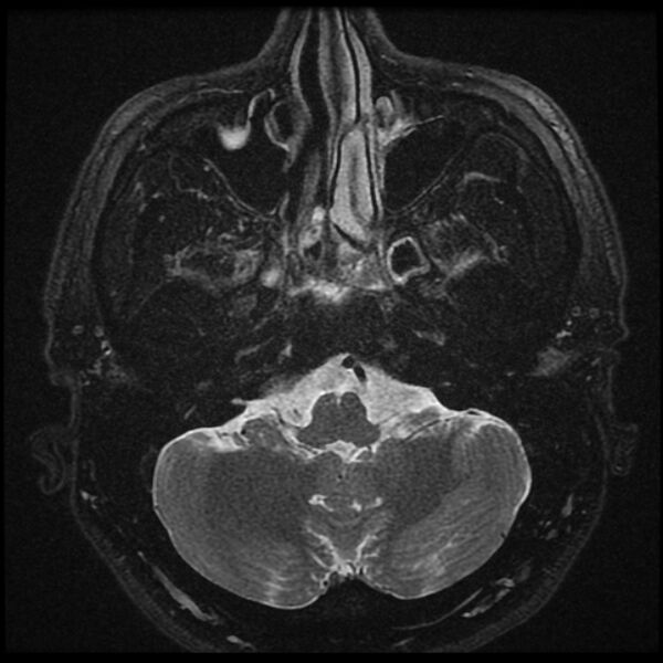 File:Acoustic schwannoma - intracanalicular (Radiopaedia 37247-39024 Axial T2 fat sat 5).jpg