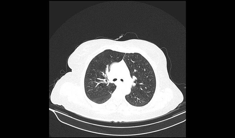 File:Acquired tracheo-esophageal fistula (Radiopaedia 51356-57103 Axial lung window 17).jpg