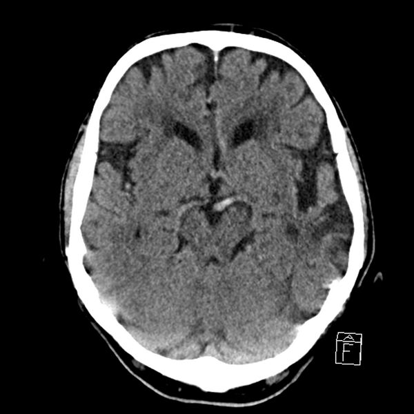 File:Acute P1 occlusion with PCA ischemia penumbra (CT perfusion) (Radiopaedia 72084-82586 Axial non-contrast 16).jpg
