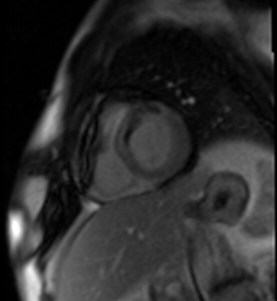 File:Acute anteroseptal myocardial infarction (Radiopaedia 68409-77945 Short axis (basal) Perfusion 35).jpg