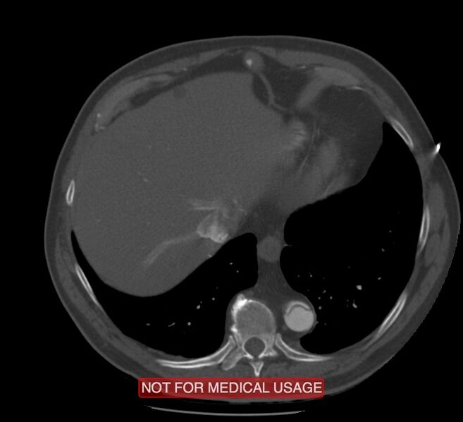 File:Acute aortic dissection - Stanford type A (Radiopaedia 40661-43285 Axial C+ arterial phase 62).jpg