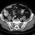 Acute appendicitis arising from a malrotated cecum (Radiopaedia 19970-19997 Axial C+ portal venous phase 32).jpg