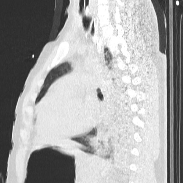 File:Acute aspiration pneumonitis (Radiopaedia 33605-34703 Sagittal lung window 52).jpg