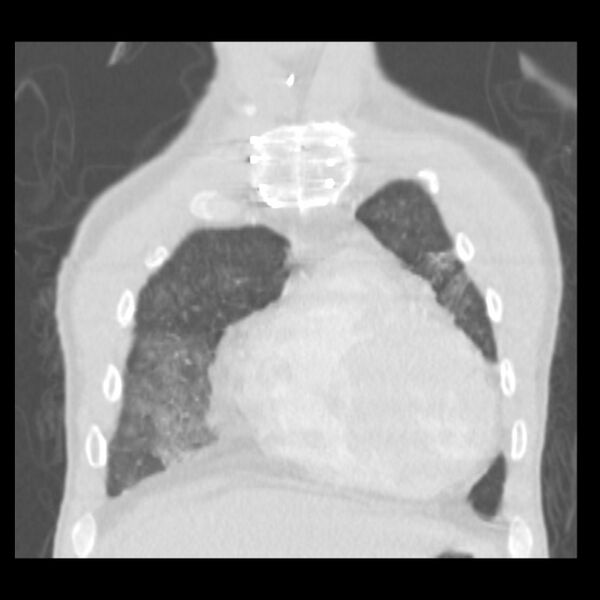 File:Acute diffuse alveolar hemorrhage (Radiopaedia 41323-44158 Coronal lung window 5).jpg