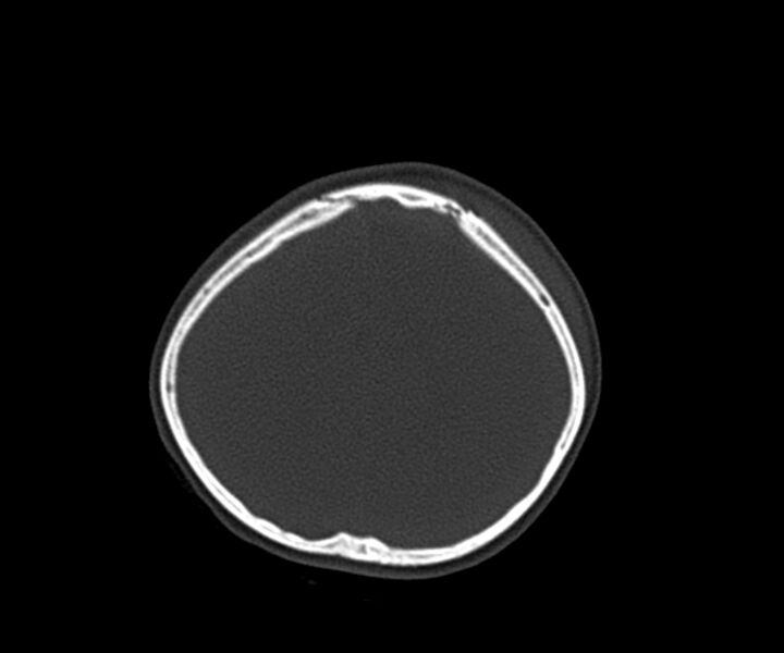File:Acute epidural hematoma (Radiopaedia 63659-72335 Axial bone window 28).jpg
