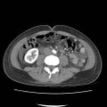 Acute myocarditis (Radiopaedia 55988-62613 Axial C+ portal venous phase 43).jpg