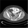 Acute pancreatitis (Radiopaedia 19136-19117 Axial C+ portal venous phase 36).jpg