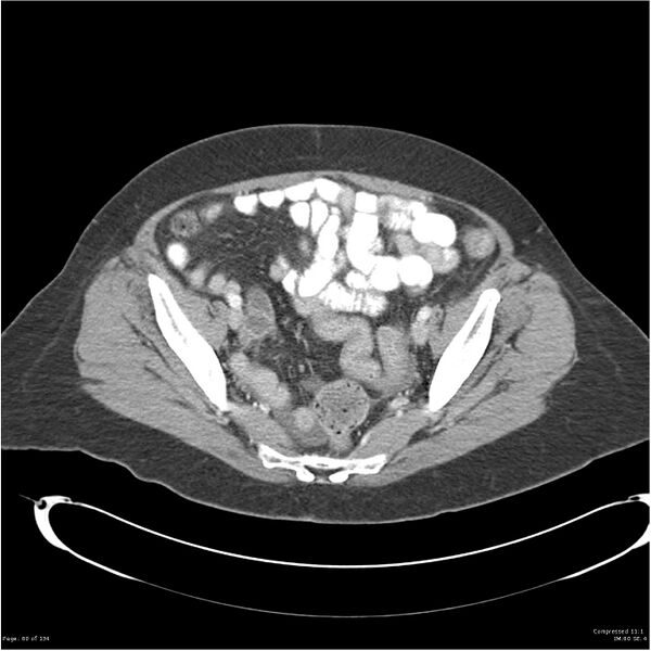 File:Acute pancreatitis (Radiopaedia 19136-19117 Axial C+ portal venous phase 36).jpg