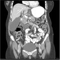 Acute pancreatitis (Radiopaedia 19136-19117 Coronal C+ portal venous phase 15).jpg