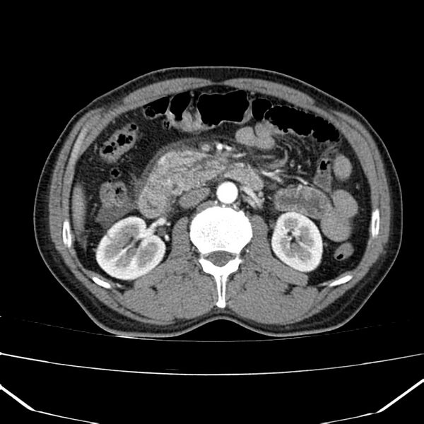 File:Acute pancreatitis (Radiopaedia 22572-22596 Axial C+ arterial phase 33).jpg