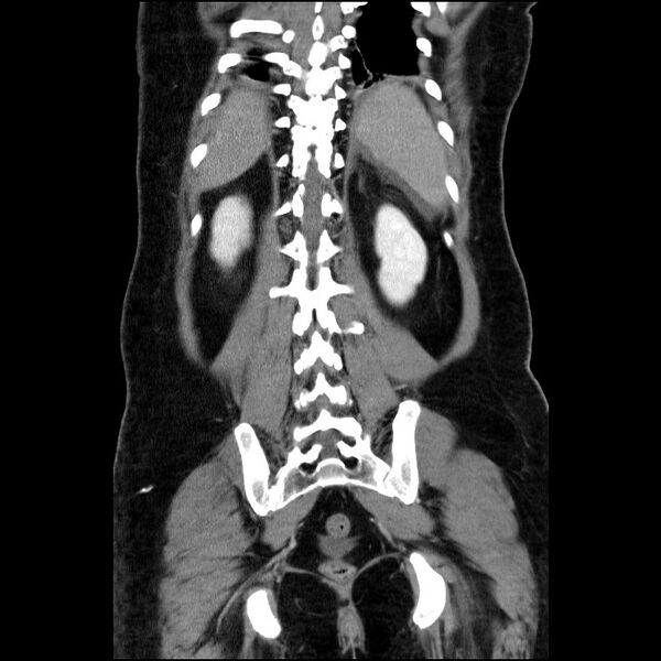 File:Acute pancreatitis (Radiopaedia 69236-79012 Coronal C+ portal venous phase 24).jpg