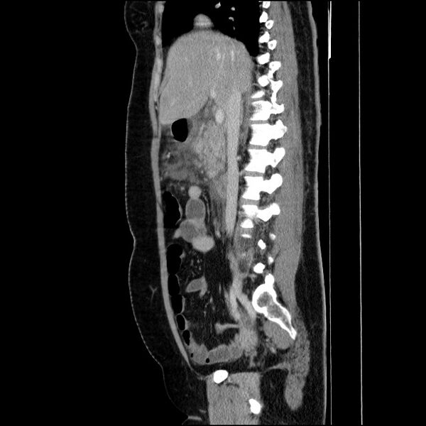 File:Acute pancreatitis (Radiopaedia 69236-79012 Sagittal C+ portal venous phase 60).jpg