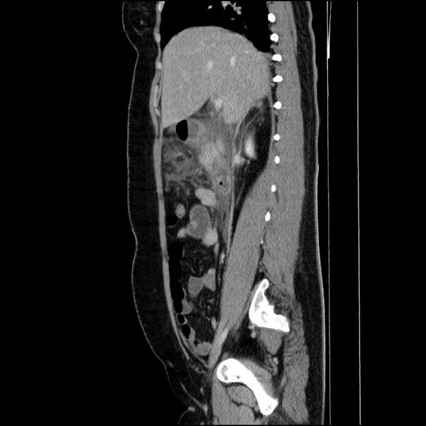 File:Acute pancreatitis (Radiopaedia 69236-79012 Sagittal C+ portal venous phase 64).jpg