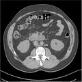 Acute pancreatitis - mild (Radiopaedia 27796-28033 Axial non-contrast 23).jpg