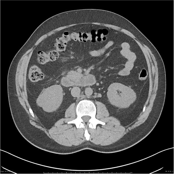 File:Acute pancreatitis - mild (Radiopaedia 27796-28033 Axial non-contrast 23).jpg