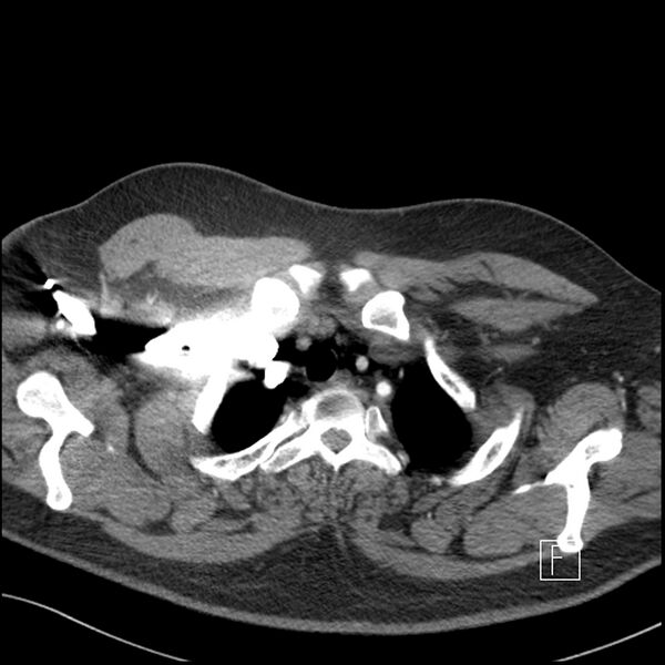 File:Acute pulmonary embolism with pulmonary infarct (Radiopaedia 73062-83768 Axial C+ CTPA 4).jpg