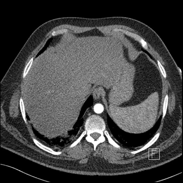 File:Acute pulmonary embolism with pulmonary infarct (Radiopaedia 73062-83768 Axial C+ CTPA 67).jpg