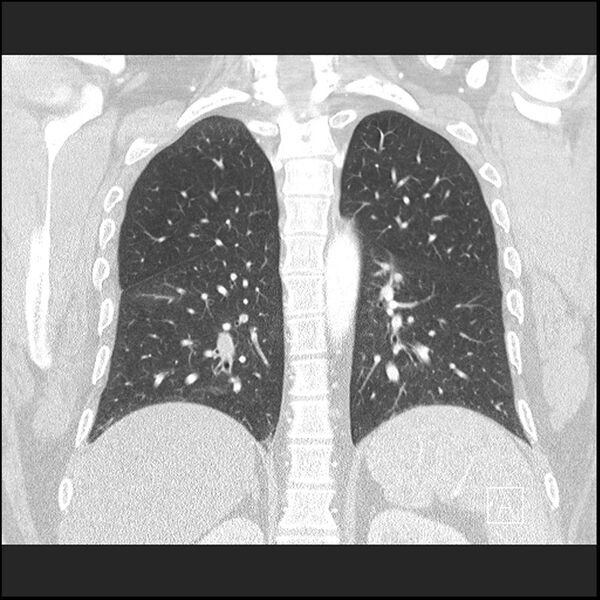 File:Acute pulmonary embolism with pulmonary infarct (Radiopaedia 73062-83768 Coronal lung window 52).jpg