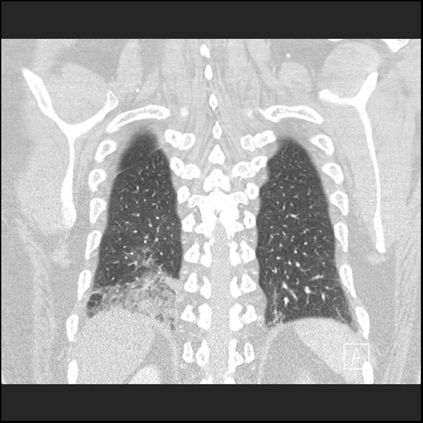 Acute pulmonary embolism with pulmonary infarct (Radiopaedia 73062-83768 Coronal lung window 64).jpg