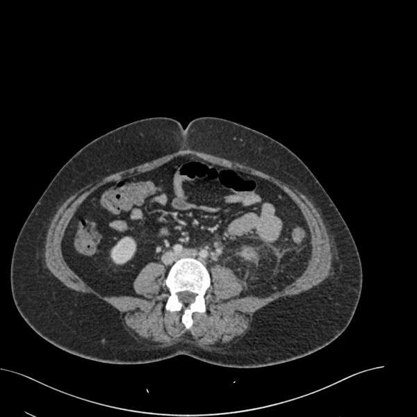 File:Acute pyelonephritis with renal vein thrombosis (Radiopaedia 58020-65053 Axial renal parenchymal phase 129).jpg