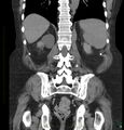 Acute renal failure post IV contrast injection- CT findings (Radiopaedia 47815-52557 Coronal non-contrast 36).jpg