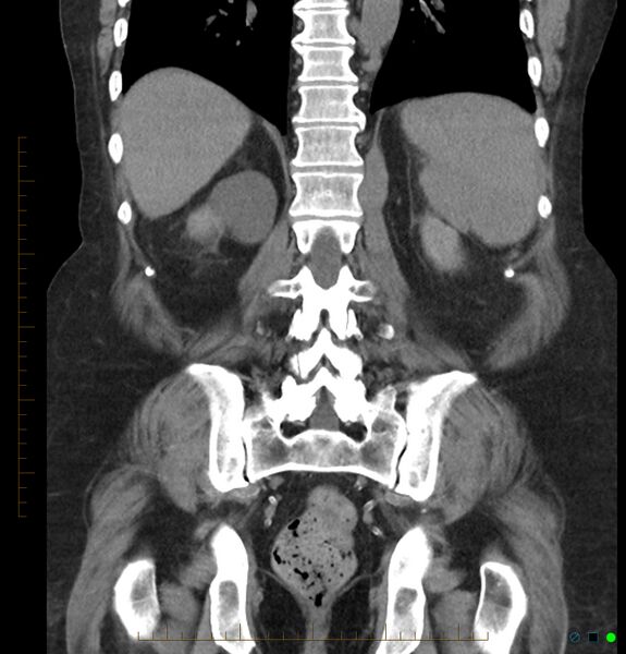 File:Acute renal failure post IV contrast injection- CT findings (Radiopaedia 47815-52557 Coronal non-contrast 36).jpg