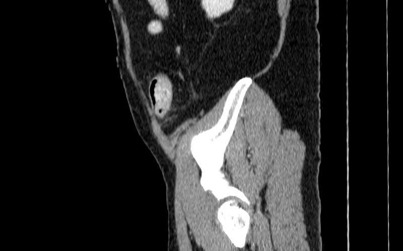 File:Acute sigmoid colon diverticulitis (Radiopaedia 55507-61976 Sagittal C+ portal venous phase 119).jpg