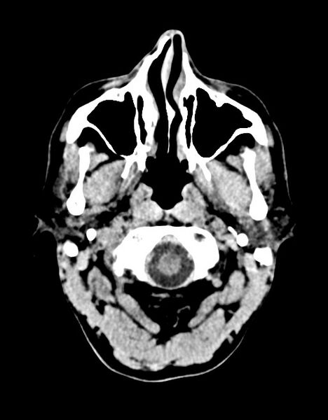 File:Acute superior cerebellar artery territory infarct (Radiopaedia 84104-99359 Axial non-contrast 63).jpg