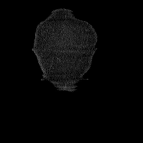File:Acute tubular necrosis (Radiopaedia 28077-28334 D 5).jpg