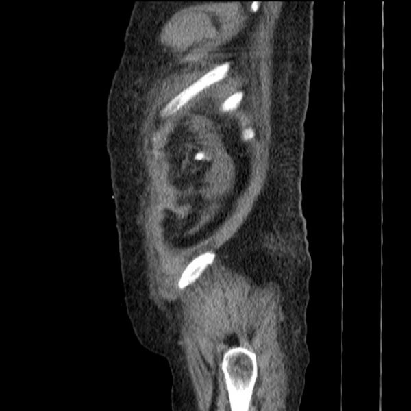 File:Acute tubular necrosis (Radiopaedia 28077-28334 Sagittal non-contrast 78).jpg