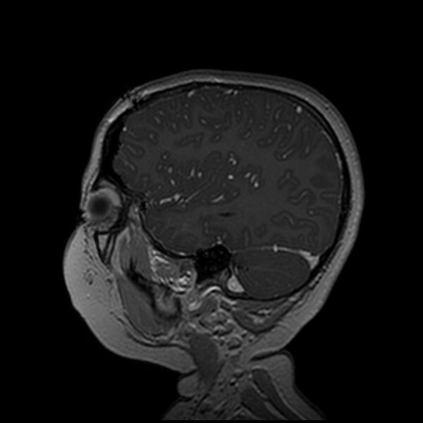 File:Adamantinomatous craniopharyngioma (Radiopaedia 77407-89529 H 30).jpg