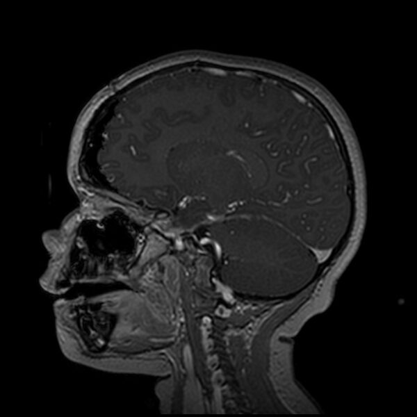 File:Adamantinomatous craniopharyngioma (Radiopaedia 77407-89529 H 50).jpg