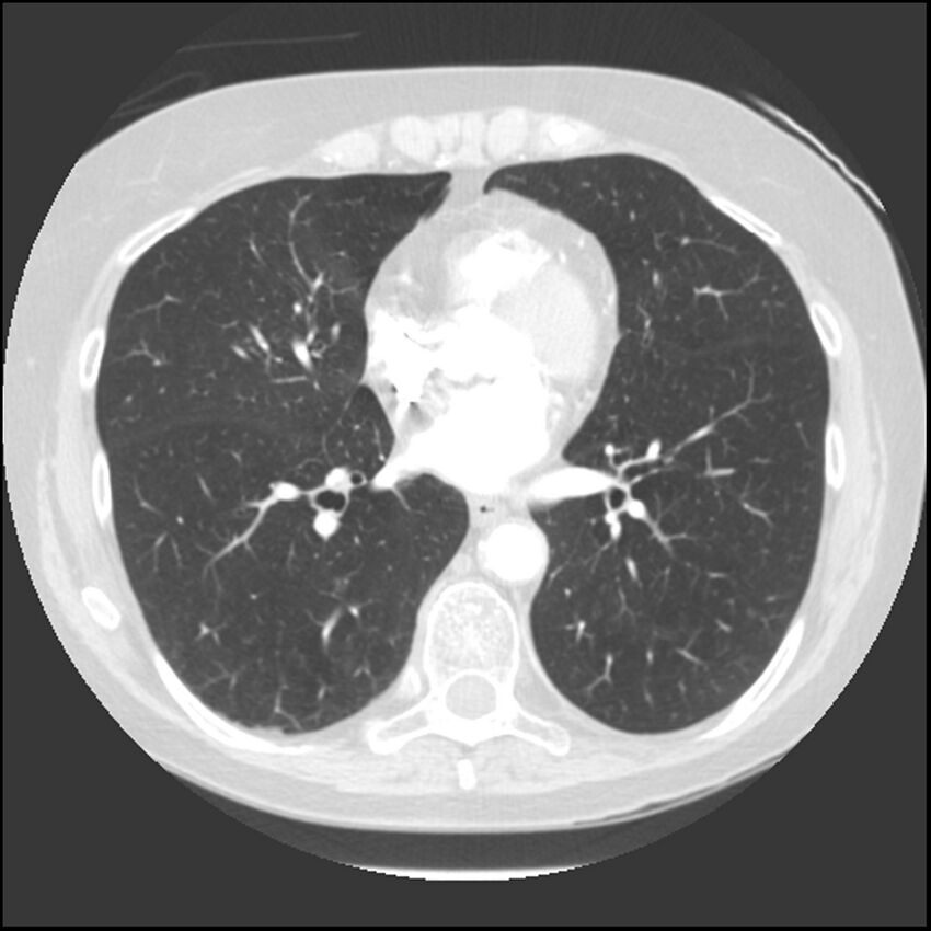 Adenocarcinoma of the lung (Radiopaedia 41015-43755 Axial lung window 73).jpg