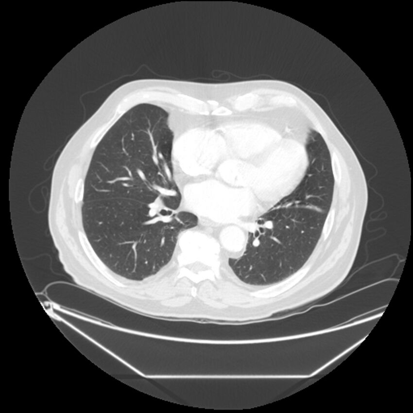 Adenocarcinoma of the lung (Radiopaedia 44876-48759 Axial lung window 48).jpg
