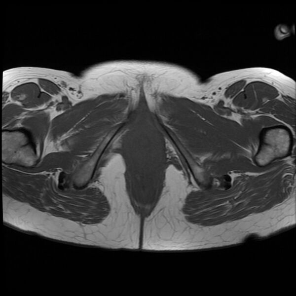 File:Adenoma malignum of the cervix (Radiopaedia 24460-24765 T1 20).jpg