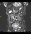 Adenomyosis (Radiopaedia 43504-46889 Coronal 2D FIESTA 8).jpg