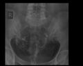 Adenomyosis (hysterosalpingogram) (Radiopaedia 63282-71855 G 1).jpg