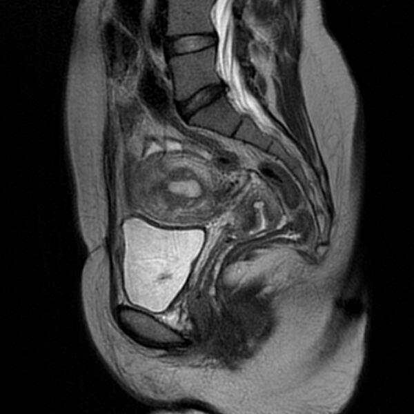 File:Adenomyosis within a septate uterus (Radiopaedia 69963-79981 Sagittal T2 14).jpg