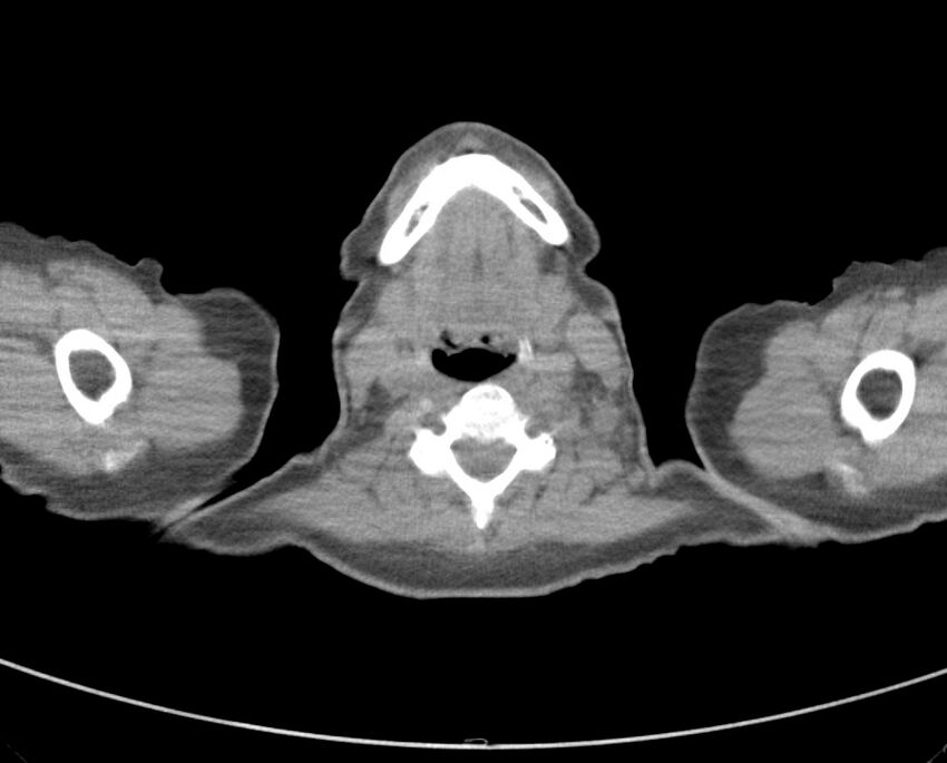 Adenosquamous lung carcinoma (Radiopaedia 22035-22030 non-contrast 2).jpg