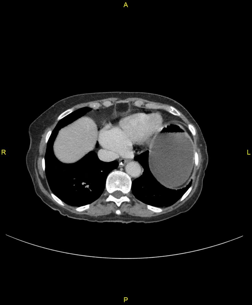 Adhesional small bowel obstruction (Radiopaedia 85402-101024 Axial C+ portal venous phase 24).jpg