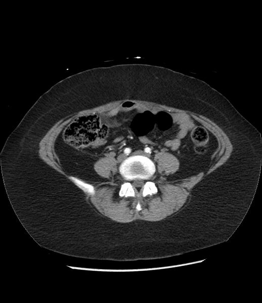 File:Adrenal cortical carcinoma with IVC invasion and thrombosis (Radiopaedia 34307-35597 Axial C+ arterial phase 58).jpg