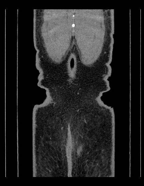 File:Adrenal myelolipoma - bilateral (Radiopaedia 74805-85810 Coronal C+ portal venous phase 39).jpg