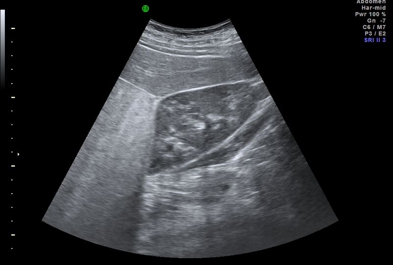 File:Adrenal myelolipoma - bilateral (Radiopaedia 74805-85811 Abdominal ultrasound 11).jpg