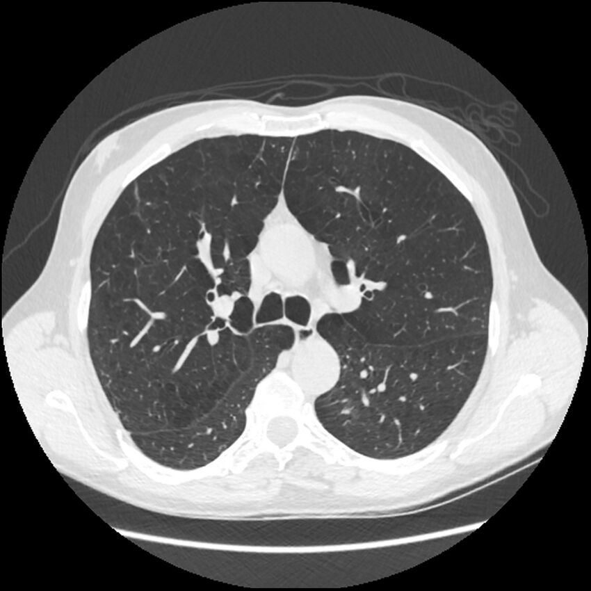 Alpha-1-antitrypsin deficiency (Radiopaedia 40993-43722 Axial lung window 88).jpg
