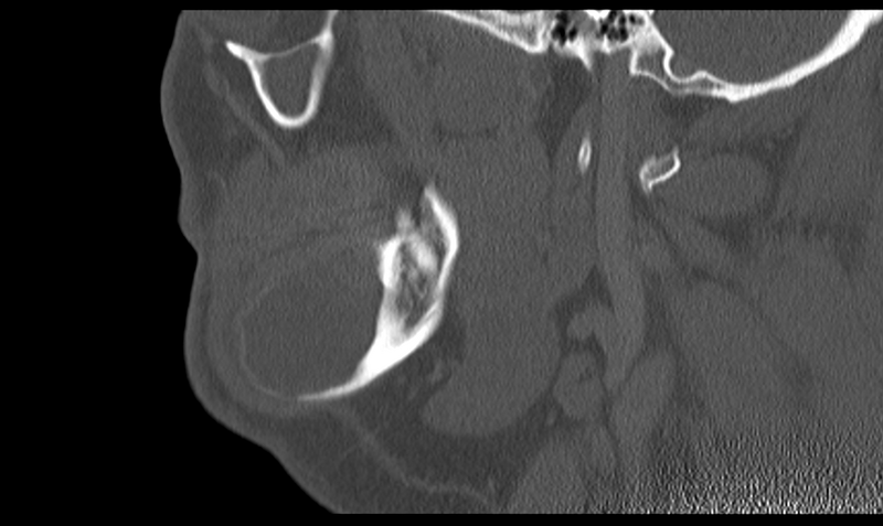 File:Ameloblastoma (Radiopaedia 33677-34806 Sagittal bone window 21).png